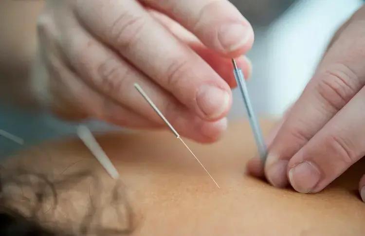 Dry needling therapy